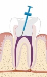 Somos especialistas en endodoncia en Mérida. Realizamos la endodoncia y colocamos una corona dental para tener de nuevo una muela funcional.