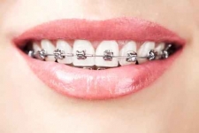 Brackets en Mérida. Corrección de la posición de los dientes por medio de brackets de calidad, precios accesibles y  facilidades de pago.