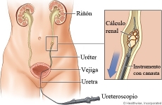 Es el procedimiento más moderno que permite entrar al riñon a través de la uretra, vejiga y uréter, para pulverizar las piedras que se encuentren con láser y extraerlas. 
Es un procedimiento ambulatorio realizado con un ureteroscopio.