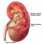 Las piedras o cálculos renales se pueden alojar dentro del riñón, en la pelvis renal o bien caer al uréter donde requieren la pronta atención del especialista. 
La Endourología es el procedimiento más moderno para disolver las piedras del riñón.
