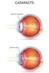 Si usted padece de catarata ocular agende su cita para recibir la mejor atención. Eliminación de la misma con microcirugía y lente intraocular 