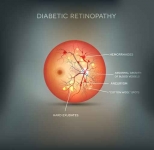 La retinopatía diabética es una complicación ocular de la diabetes que está causada por el deterioro de los vasos sanguíneos que irrigan la retina