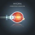La miopía es una anomalía o defecto del ojo que produce una visión borrosa o poco clara de los objetos lejanos