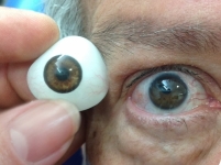 La rehabilitación con prótesis después de la pérdida de un ojo tiene muy buenos resultados cosméticos y hace que el paciente se sienta mejor