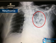 Paciente con neumonía en uno de sus pulmones (en nuestro medio igual la conocen como pulmonía). Ofrezco tratamiento a estos casos.