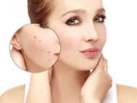 Tratamiento eficaz para eliminación de acné en jóvenes y adultos para lucir un rostro espectacular