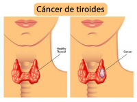 El mejor servicio de cirugía por cáncer de tiroides