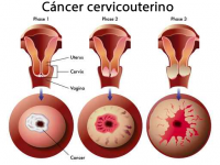 Especialista en cirugía de cáncer de cervicouterino, de endometrio y ovario. 