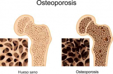 Tratamiento para fortalecer los huesos en pacientes con osteoporosis o cirugía de mínima invasión en casos de fracturas. 