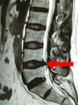 Resonancia magnética de paciente con hernia de disco. Se lleva al cabo cirugía de columna exitosa. El paciente actualmente se encuentra haciendo normalmente su vida cotidiana.