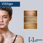 El Dr. Cervera le ofrece tratamiento de vanguardia en casos de vitiligo (o mal de pinto como se le conoce en nuestro medio)
