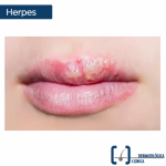 No permita que el herpes avance de forma descontrolada. Ante los primeros síntomas es conveniente solicitar su cita para atención inmediata
