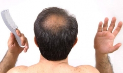 En la actualidad ya existen tratamientos novedosos para la alopecia o caída del cabello en hombres y mujeres y un dermatólogo puede ayudarle en estos casos