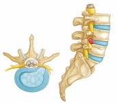 Experto en tratamiento conservador y cirugía de mínima invasión para hernia discal. En la imagen se representa una hernia de disco en columna lumbar.