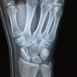 Atención a fractura de escafoides (hueso de la muñeca) en paciente.