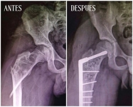Antes y después de cirugía para reparar una fractura en la cadera derecha (secundaria a tumor benigno) en paciente de 12 años.