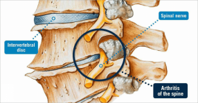 En la osteoartritis de la columna vertebral, los discos se estrechan y se forman espolones óseos.