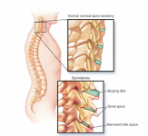 La espondilosis cervical provoca un estrechamiento del espacio que necesitan la médula espinal y las raíces nerviosas que pasan por la columna vertebral hacia el resto del cuerpo.