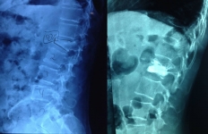 Paciente masculino de 70 años con fractura de vértebra por osteoporosis en la cual se realiza Xifoplastia por técnica mínimamente invasiva con excelentes resultados.