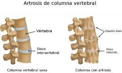 Atención a pacientes con artrosis de columna. La artrosis es una enfermedad degenerativa a diferencia de la osteoartritis que es causada por una infección. 