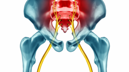 Comúnmente conocido como dolor de ciática, es un dolor que se extiende a lo largo del nervio ciático. Los síntomas pueden presentarse desde la espalda baja hasta una o ambas piernas, pudiendo causar debilidad, entumecimiento u hormigueo.