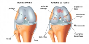 La osteoartritis, se produce cuando el cartílago protector que amortigua los extremos de los huesos se desgasta con el tiempo. También se conoce como artrosis y afecta las manos, las rodillas, las caderas y la columna vertebral