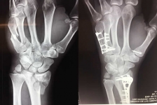 Fractura de brazo o fractura de húmero, fractura de codo, fractura de muñeca o radio distal