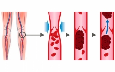 Manejo y resolución de trombosis arterial y venosa. Trombosis venosa profunda (coágulo de sangre en una vena profunda, generalmente en las piernas pero que puede llegar a los pulmones).