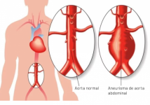 Manejo de aneurismas arteriales / aneurisma de aorta abdominal o aneurisma abdominal por medio de cirugía de mínima invasión