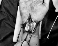 Reconstrucción del nervio periférico, ya sea con sutura microquirúrgica o por medio de injertos de nervio