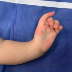 La cirugía de mano congénita se realiza para corrección de dedo extra, dedo más grande, ausencia de dedos, deformidades del antebrazo, mano zamba y sinostosis congénita